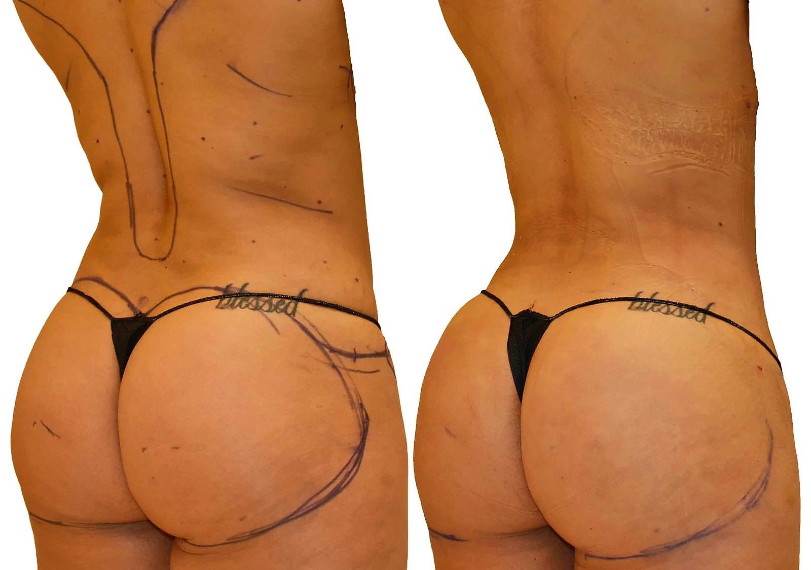 Before/After Fat Transfer, BBL before and after, actual patient of Dr. Long