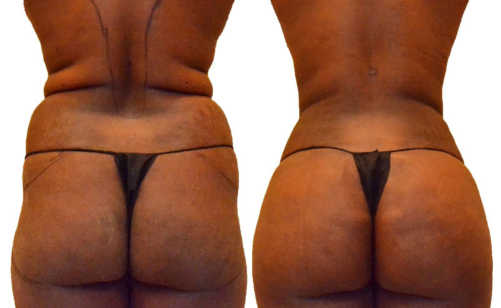Before/After Fat Transfer, BBL before and after, actual patient of Dr. Long