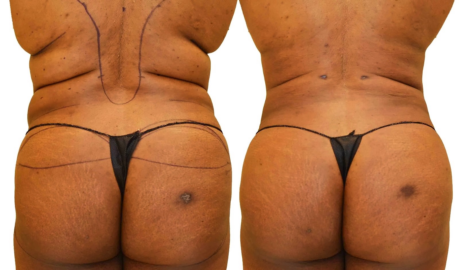 Before/After Fat Transfer, BBL before and after, actual patient of Dr. Long