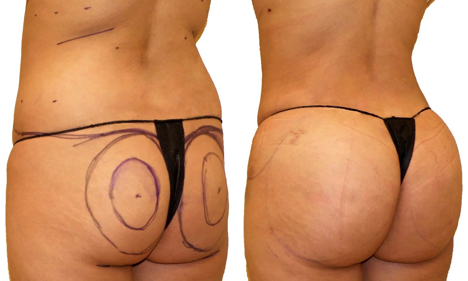 Before/After Fat Transfer, BBL before and after, actual patient of Dr. Long