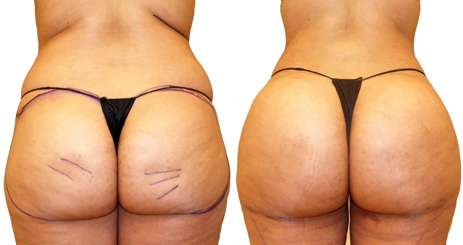 Before/After Fat Transfer, BBL before and after, actual patient of Dr. Long