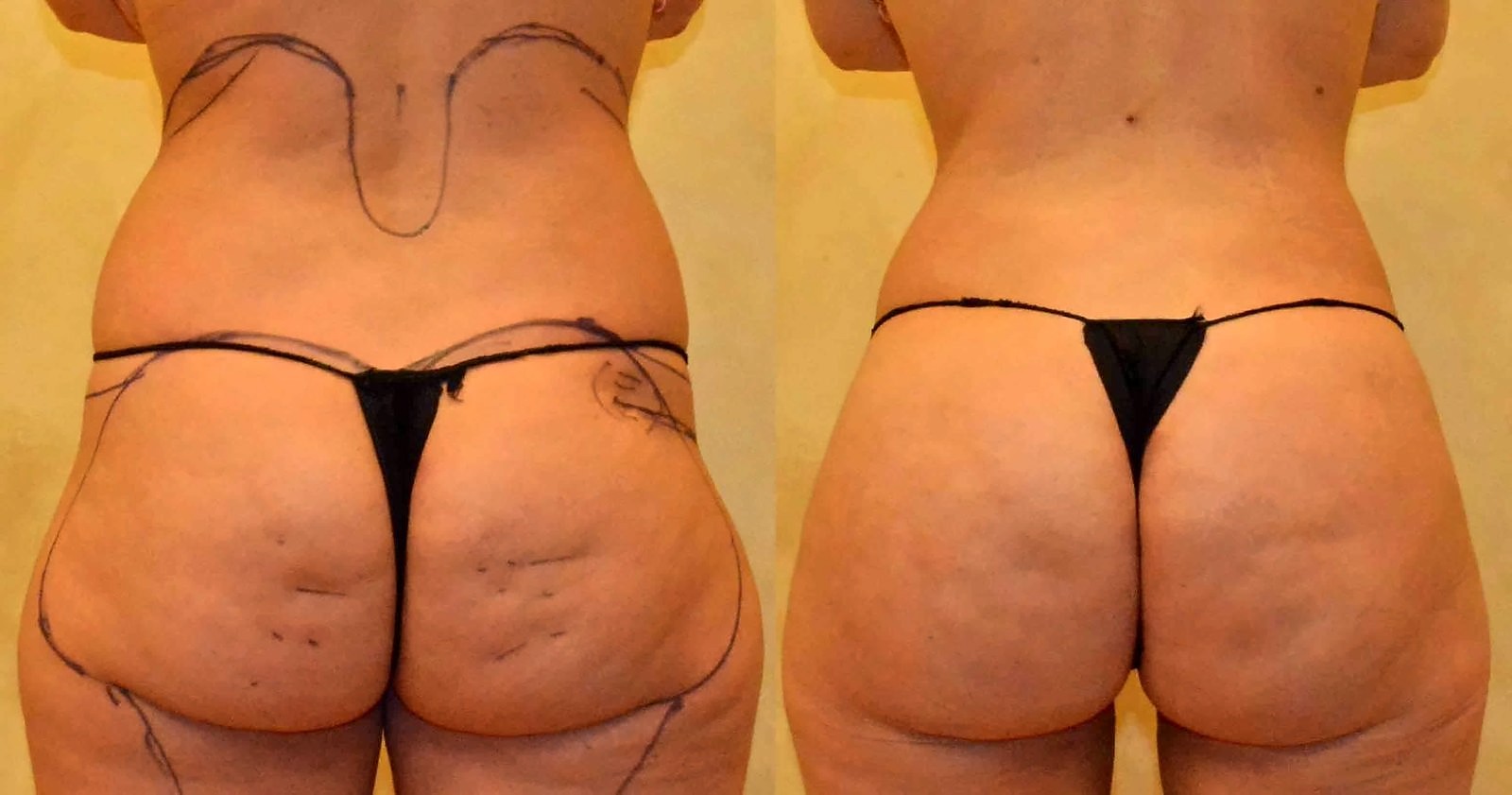 Before/After Fat Transfer, BBL before and after, actual patient of Dr. Long