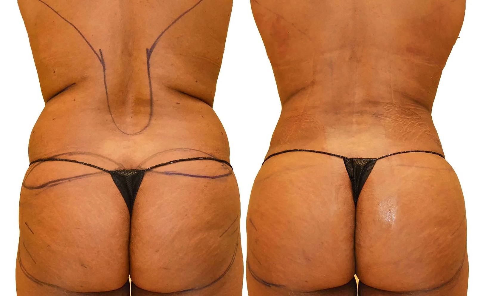 Before/After Fat Transfer, BBL before and after, actual patient of Dr. Long