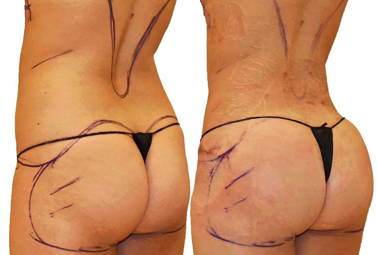 Before/After Fat Transfer, BBL before and after, actual patient of Dr. Long