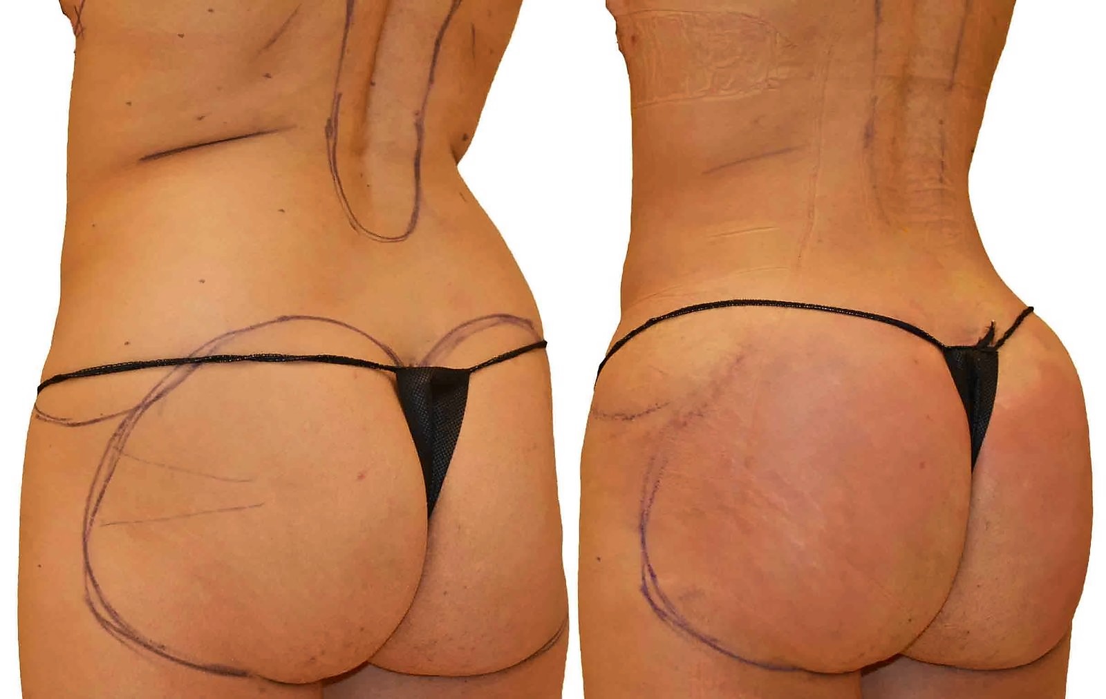Before/After Fat Transfer, BBL before and after, actual patient of Dr. Long