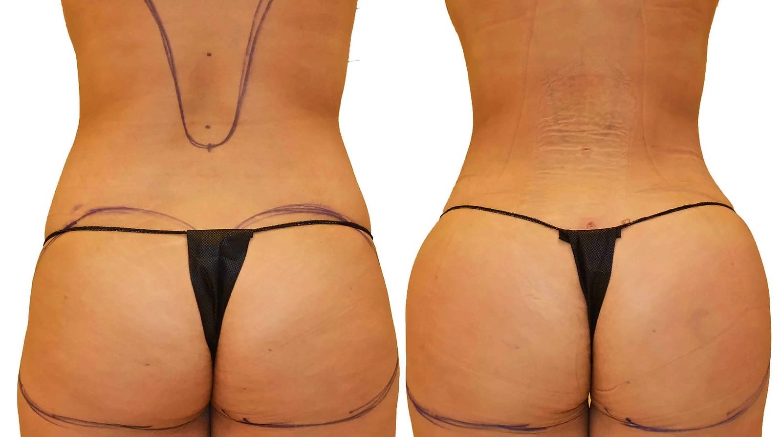 Before/After Fat Transfer, BBL before and after, actual patient of Dr. Long