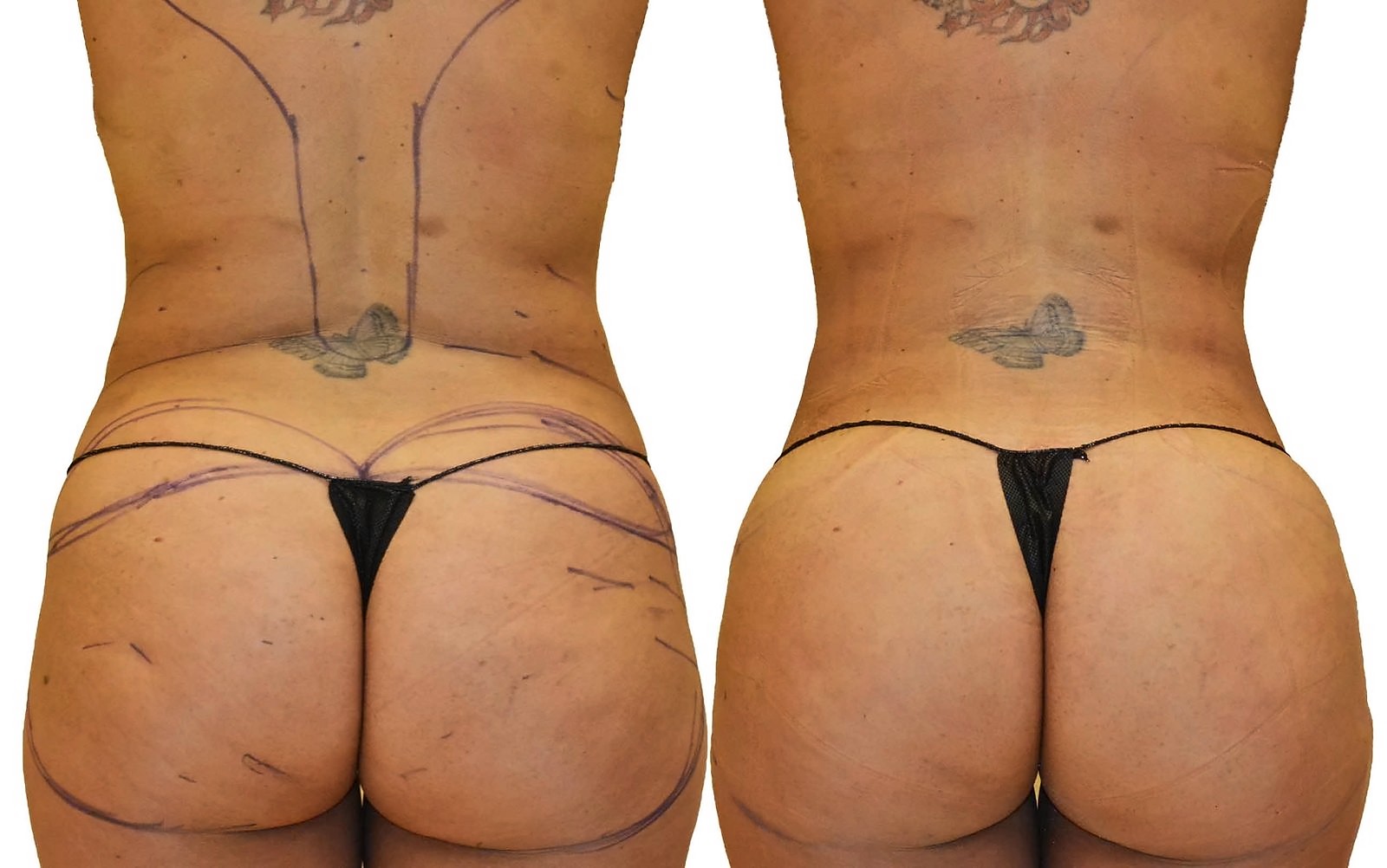 Before/After Fat Transfer, BBL before and after, actual patient of Dr. Long