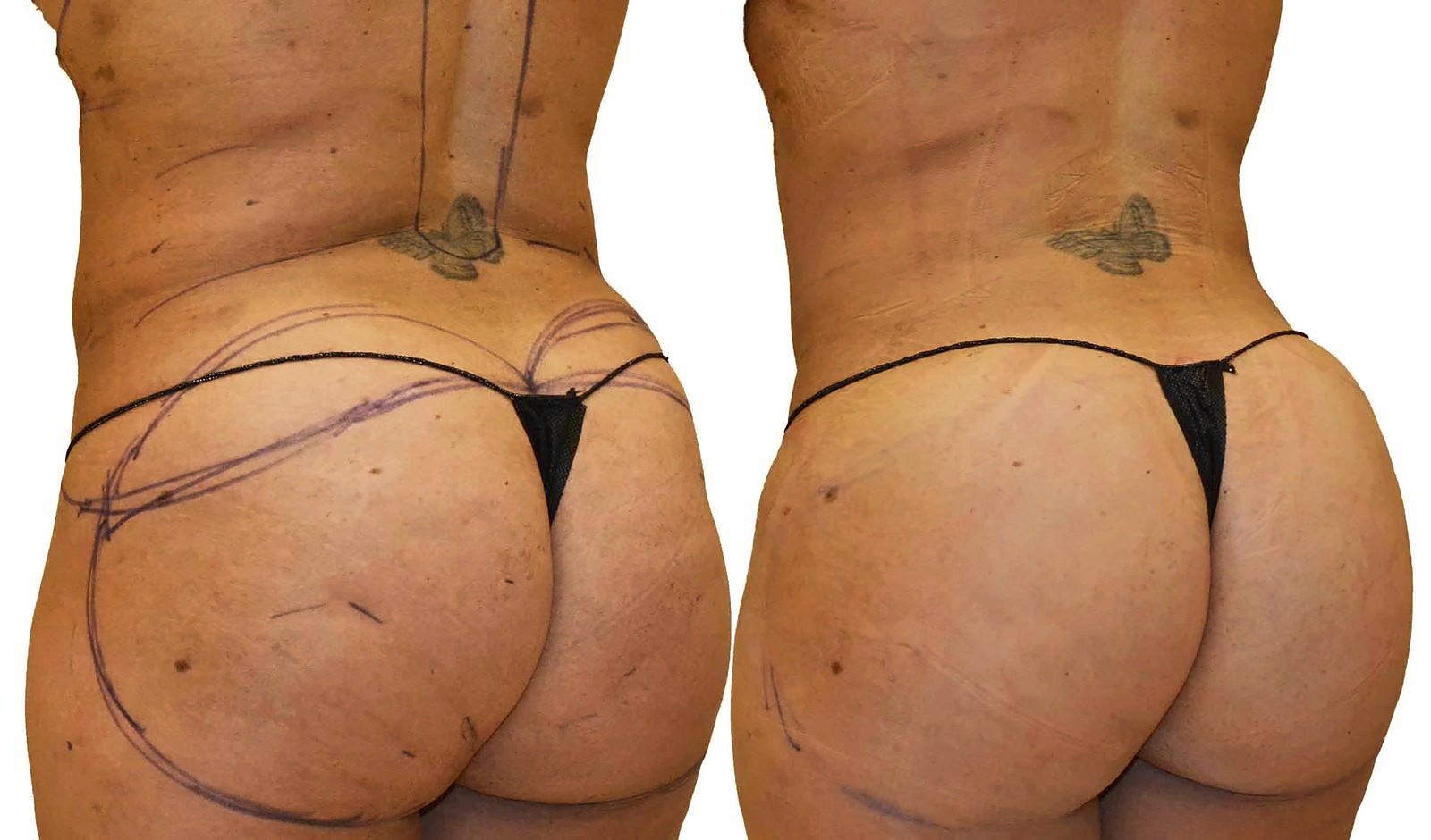 Before/After Fat Transfer, BBL before and after, actual patient of Dr. Long