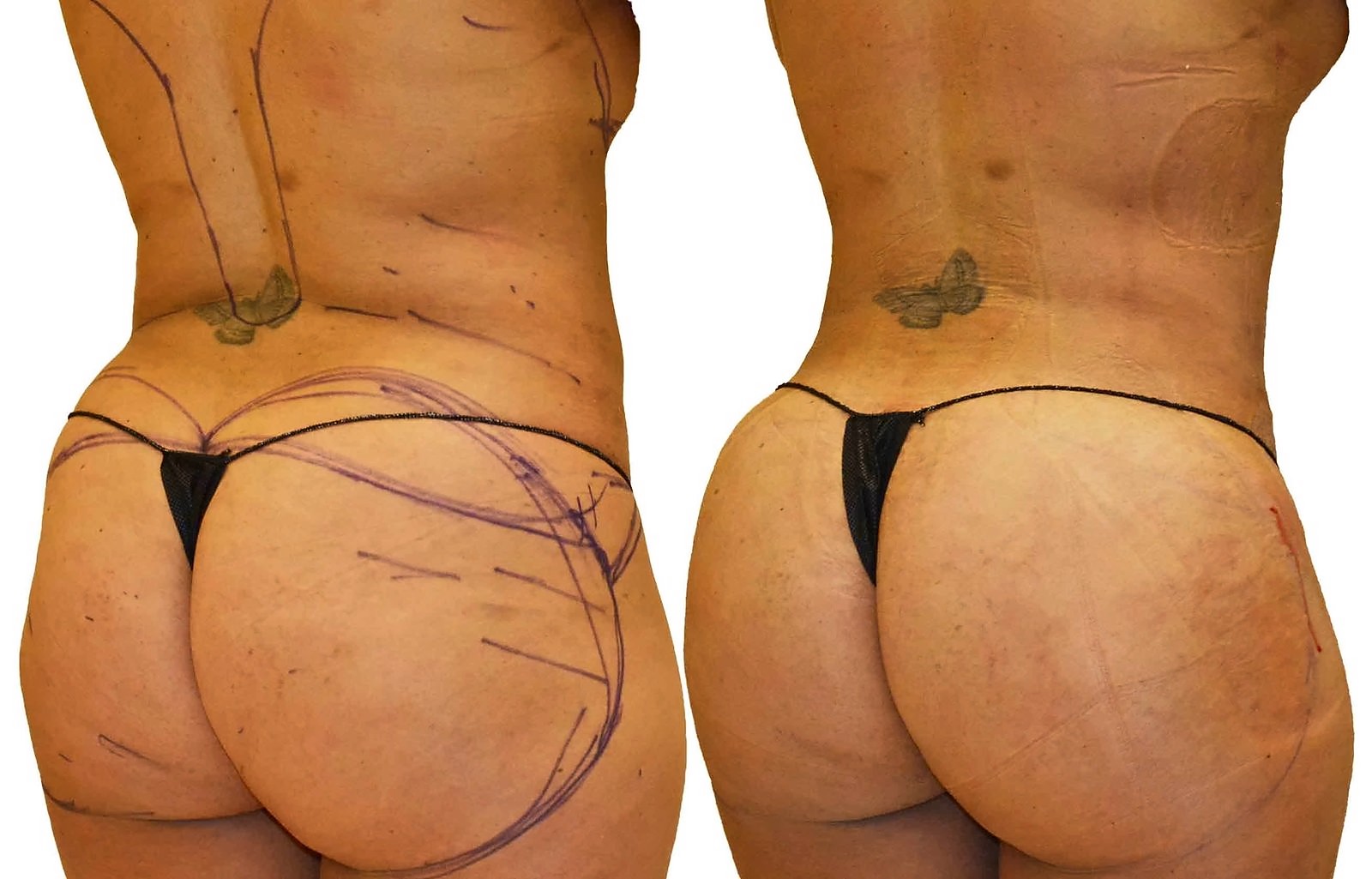 Before/After Fat Transfer, BBL before and after, actual patient of Dr. Long