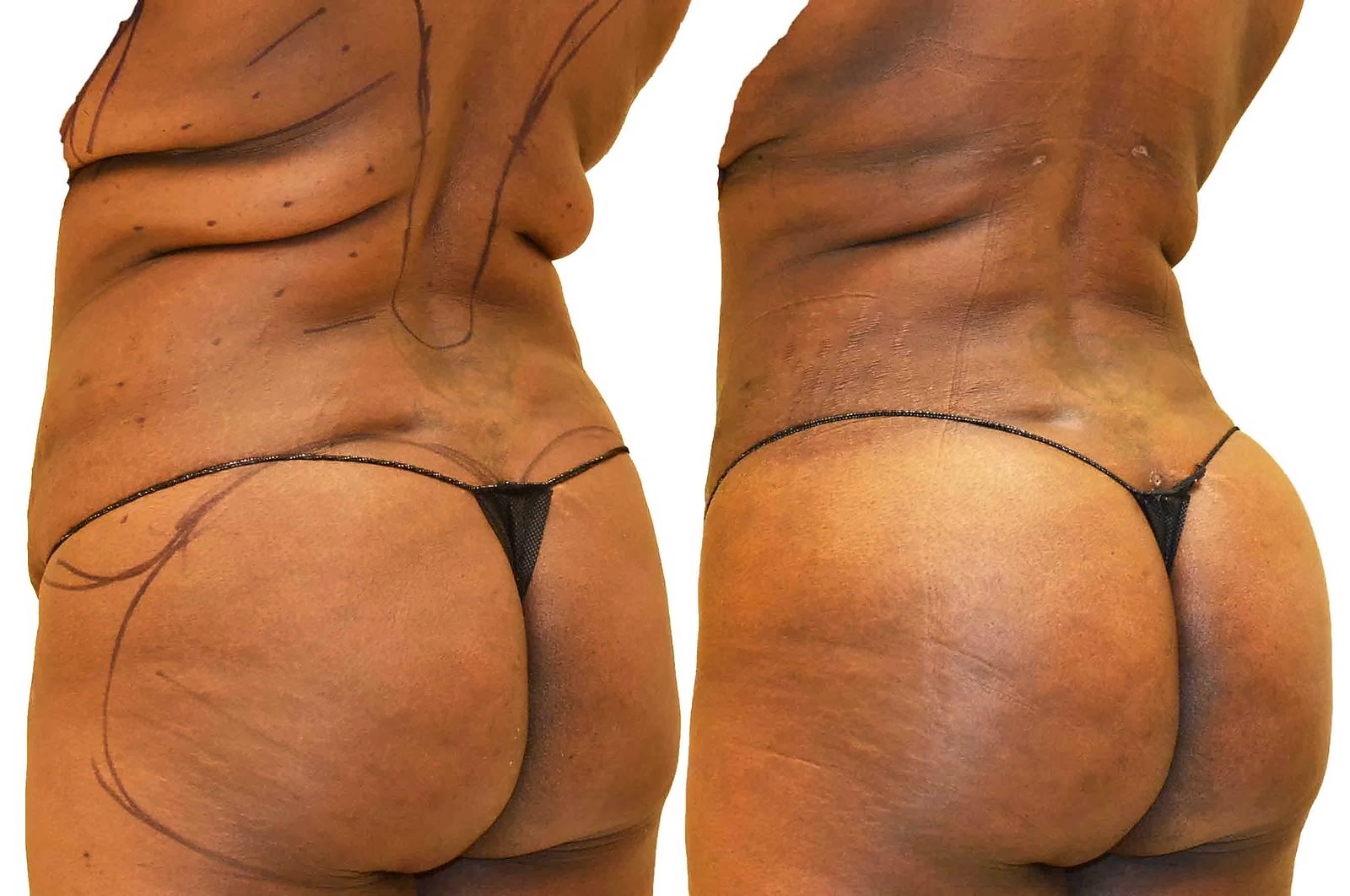 Before/After Fat Transfer, BBL before and after, actual patient of Dr. Long