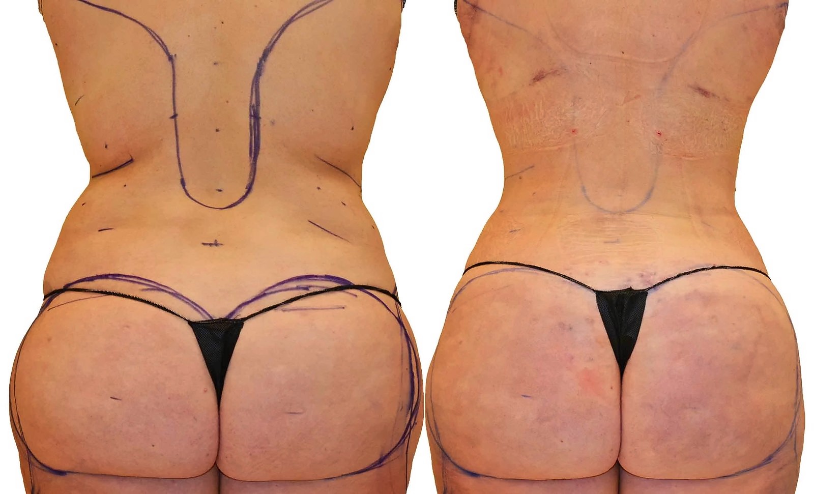 Before/After Fat Transfer, BBL before and after, actual patient of Dr. Long