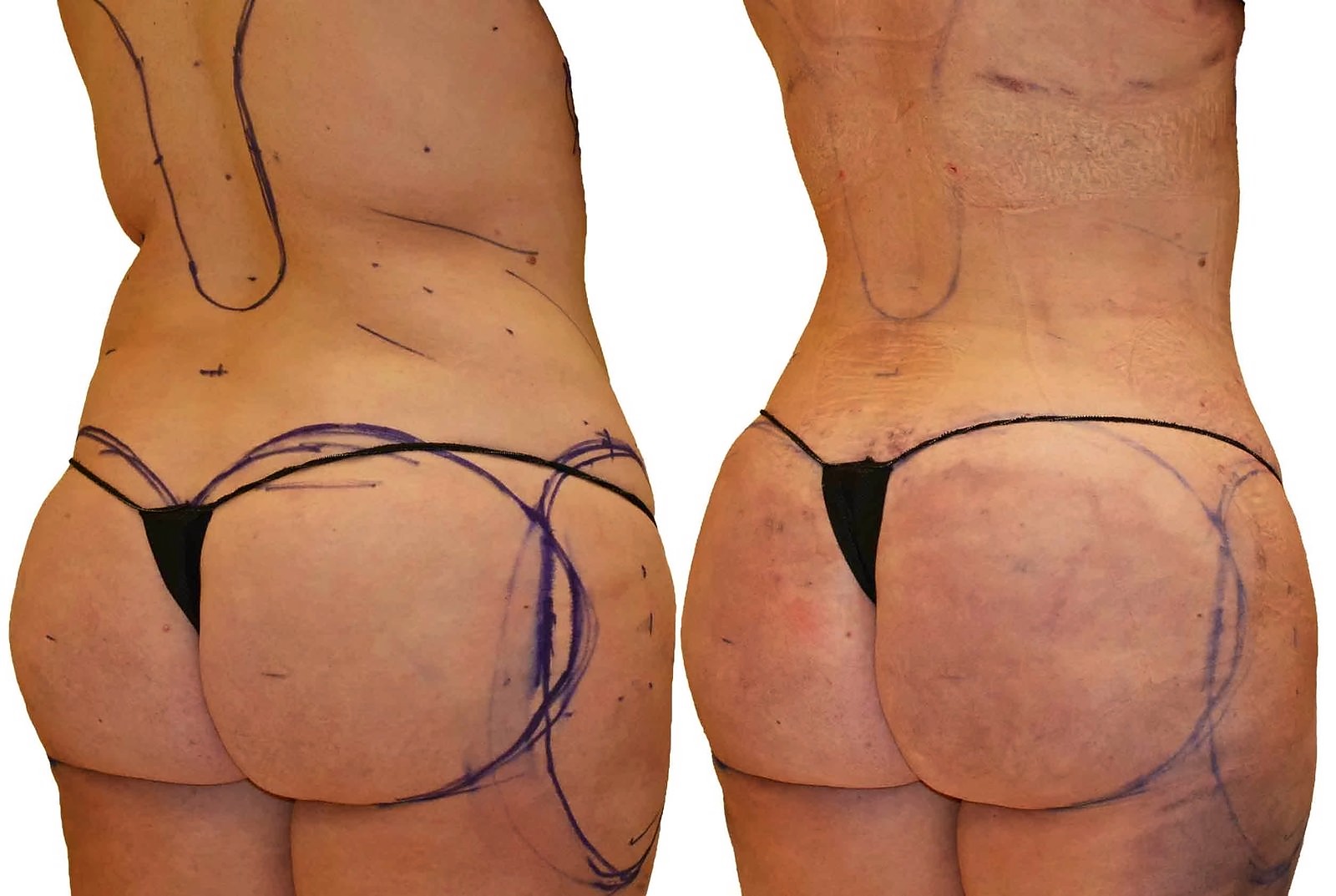 Before/After Fat Transfer, BBL before and after, actual patient of Dr. Long