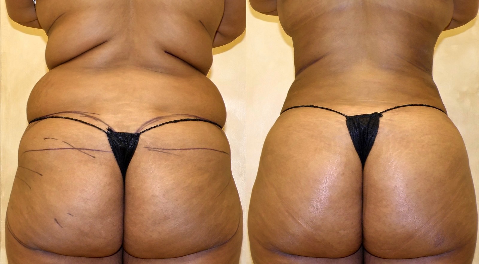 Before/After Fat Transfer, BBL before and after, actual patient of Dr. Long