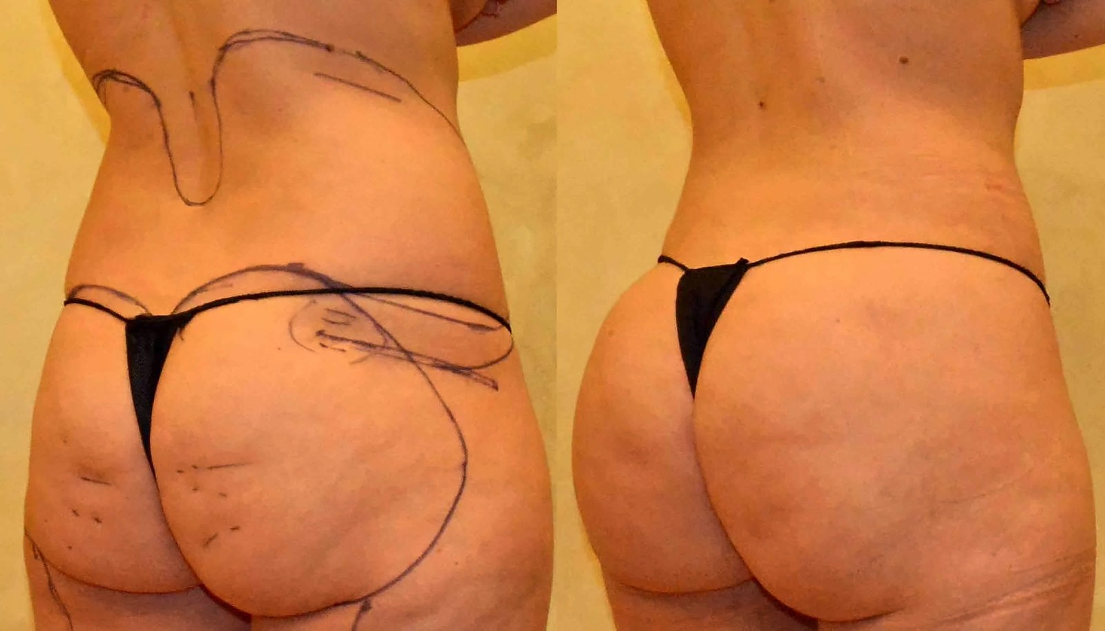 Before/After Fat Transfer, BBL before and after, actual patient of Dr. Long