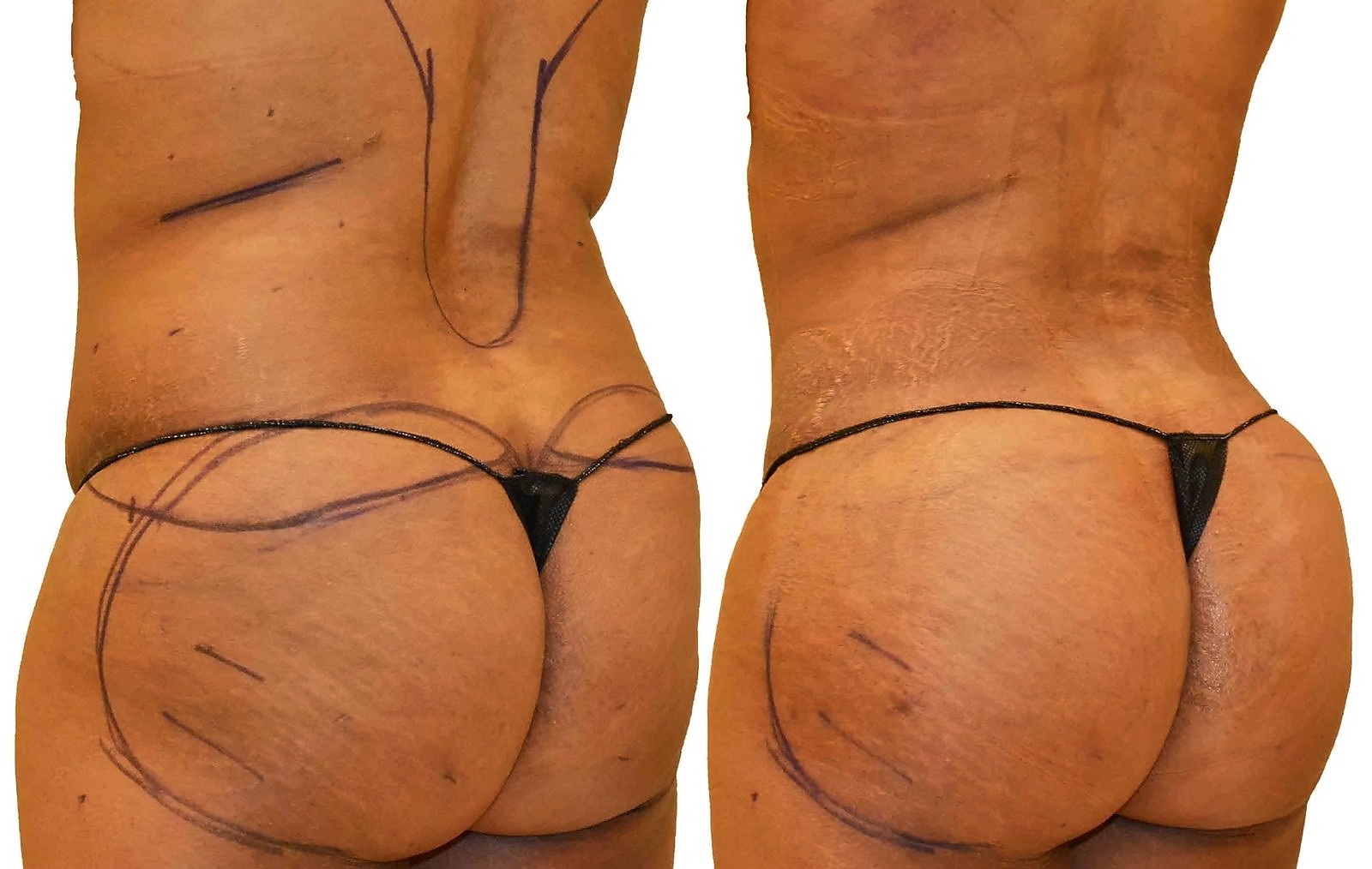 Before/After Fat Transfer, BBL before and after, actual patient of Dr. Long