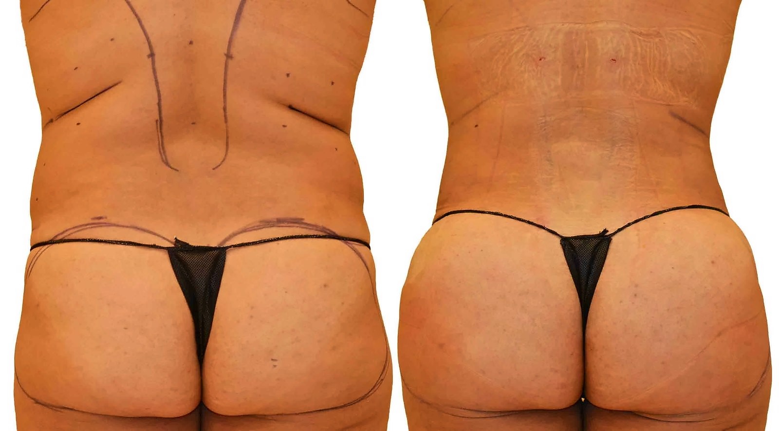 Before/After Fat Transfer, BBL before and after, actual patient of Dr. Long