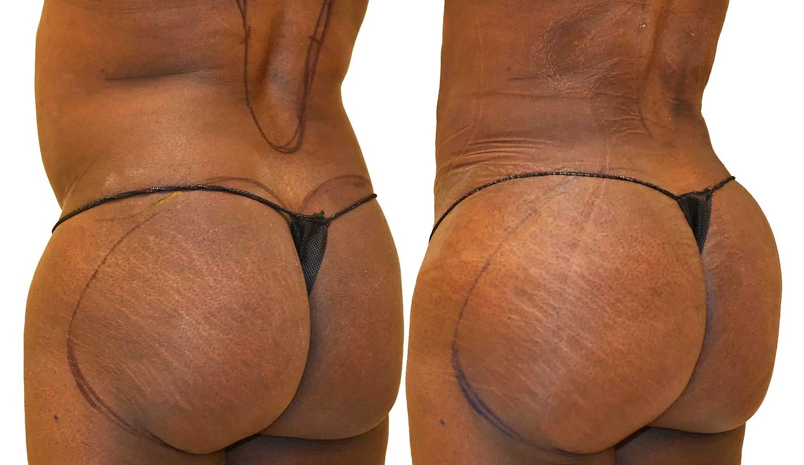 Before/After Fat Transfer, BBL before and after, actual patient of Dr. Long