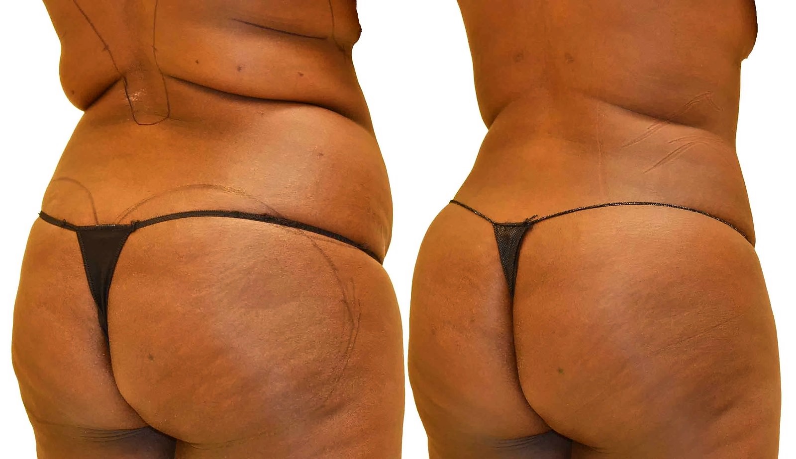 Before/After Fat Transfer, BBL before and after, actual patient of Dr. Long