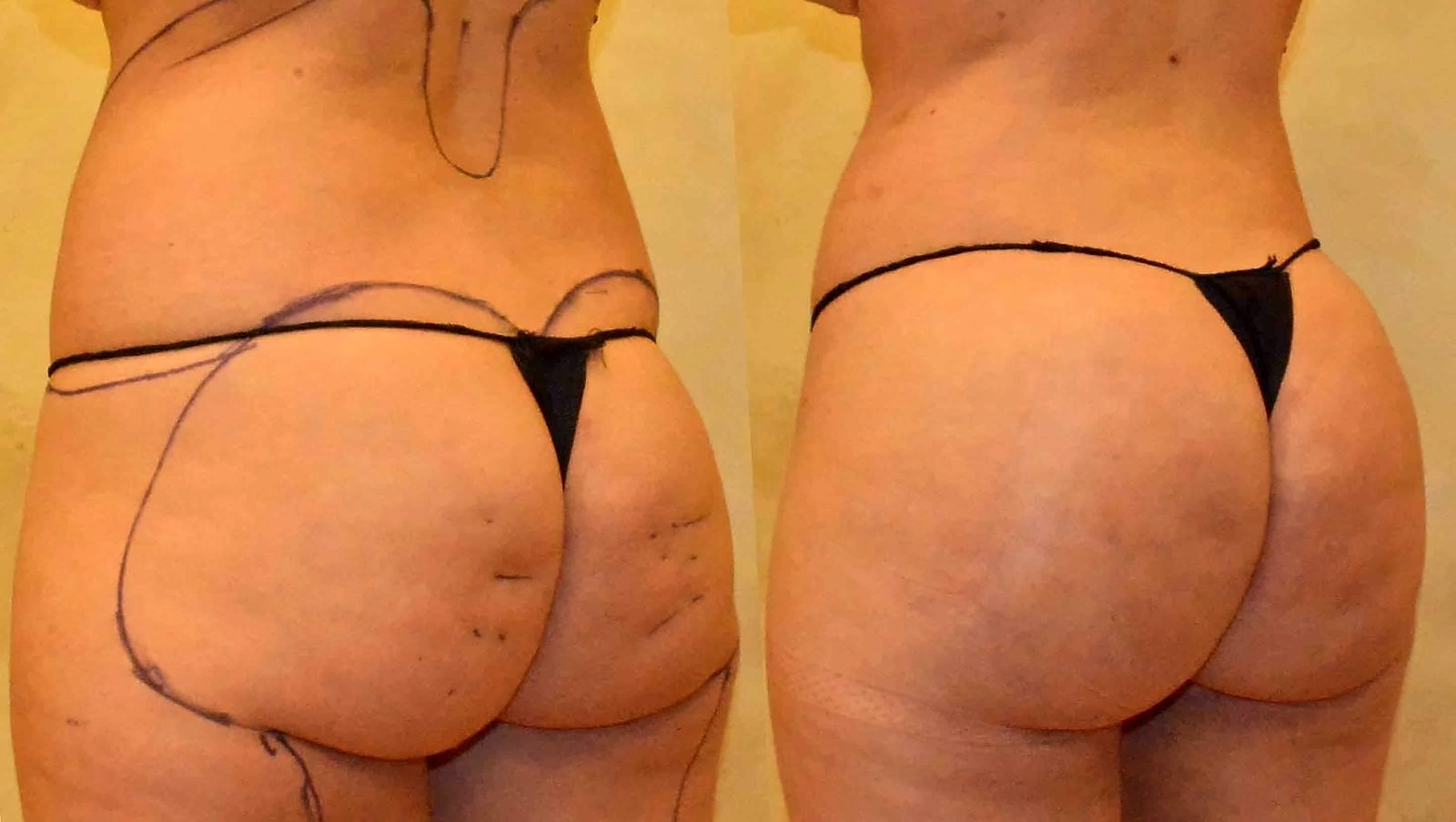 Before/After Fat Transfer, BBL before and after, actual patient of Dr. Long