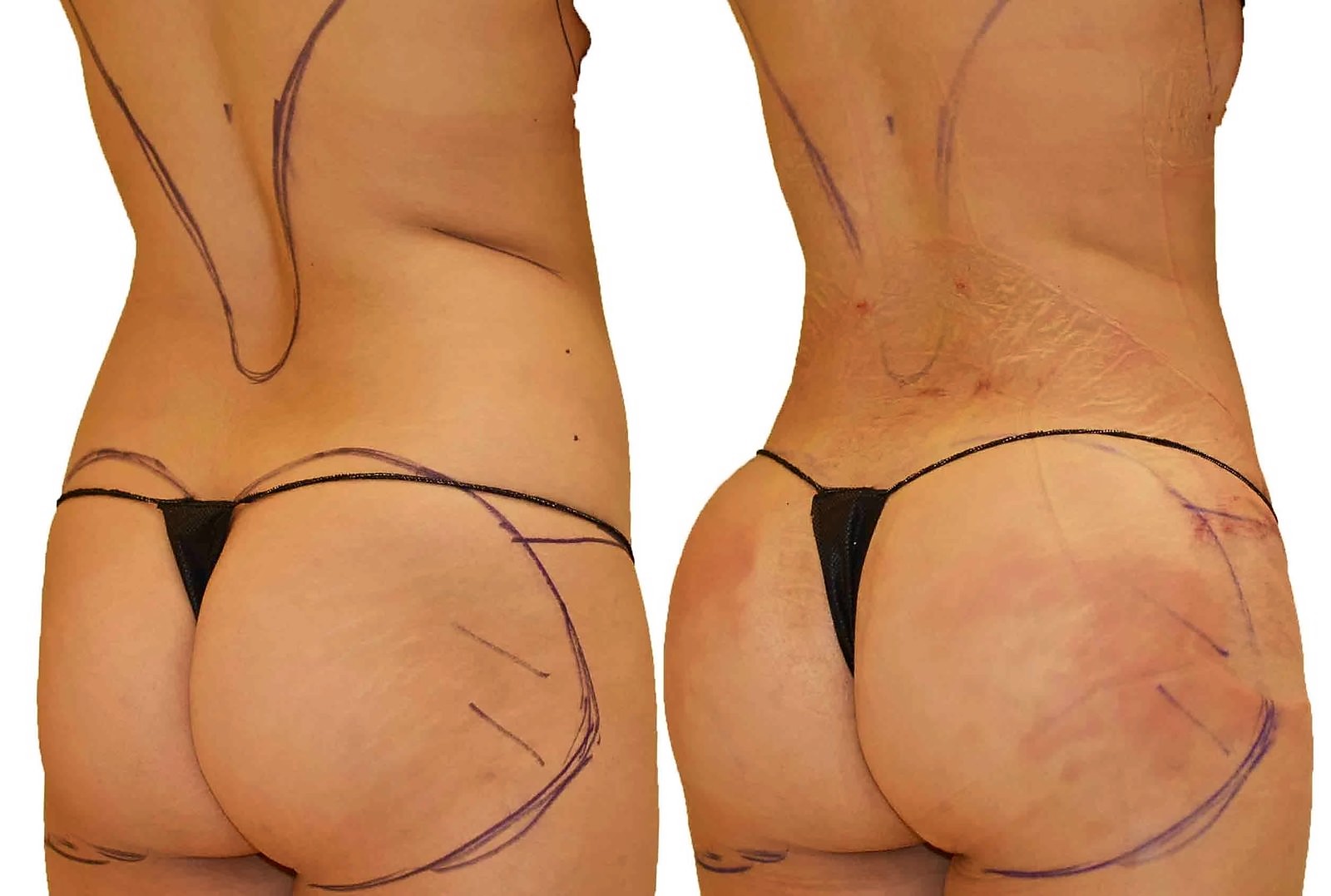 Before/After Fat Transfer, BBL before and after, actual patient of Dr. Long