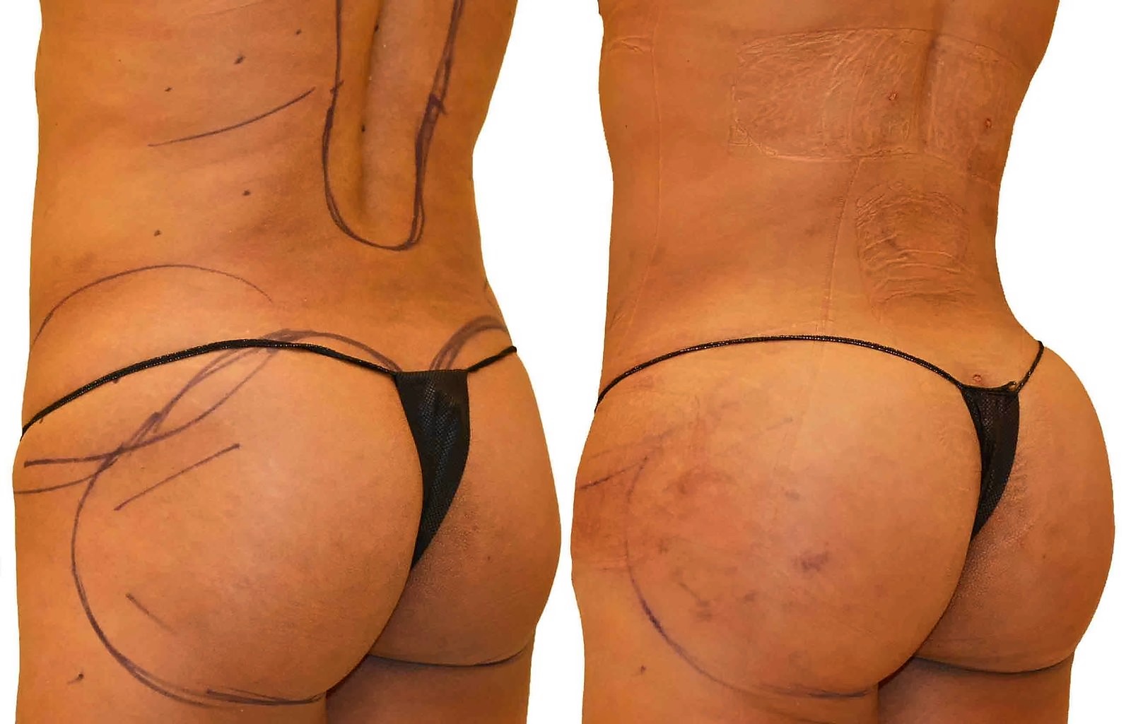 Before/After Fat Transfer, BBL before and after, actual patient of Dr. Long