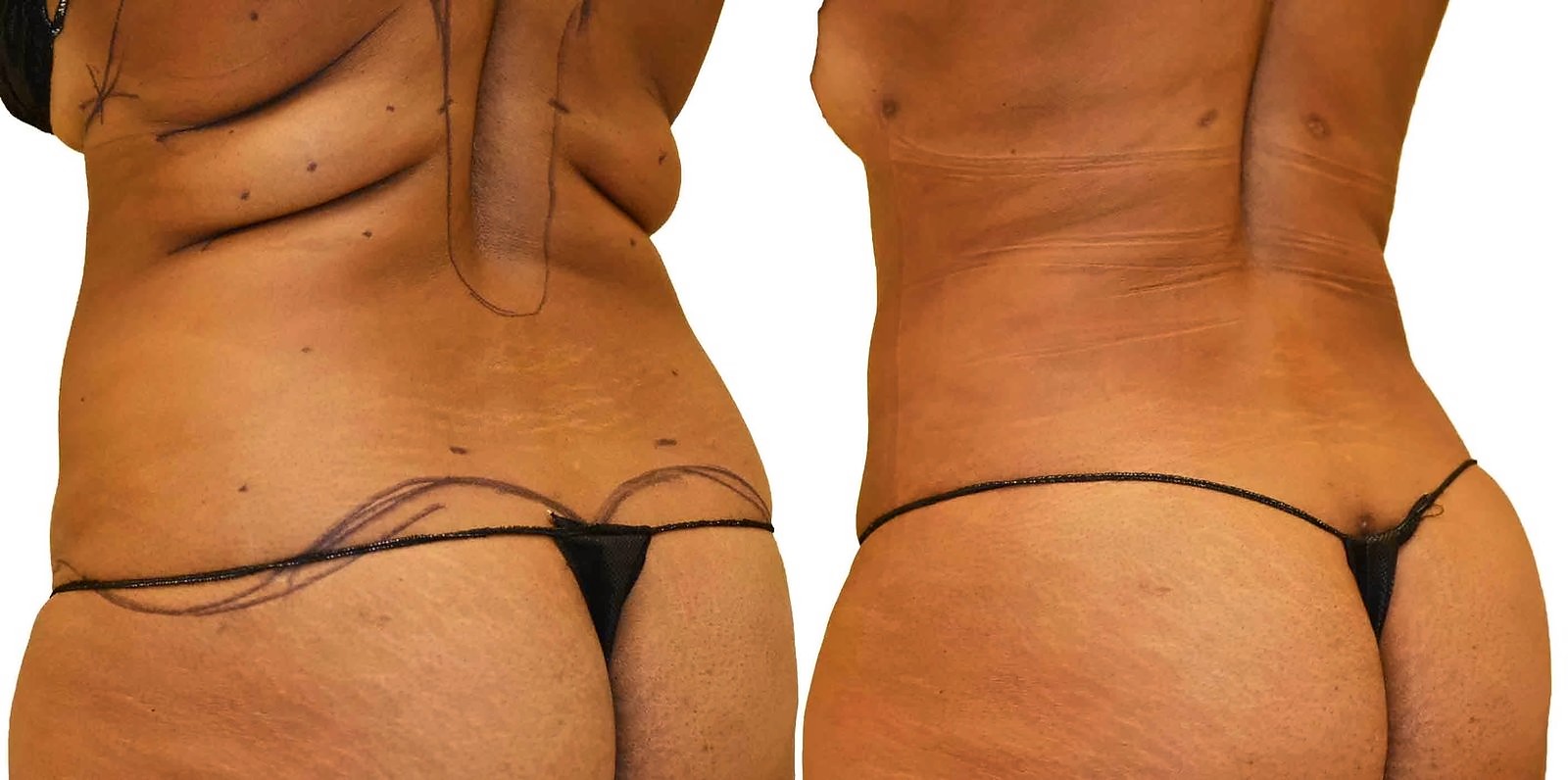 Before/After Fat Transfer, BBL before and after, actual patient of Dr. Long