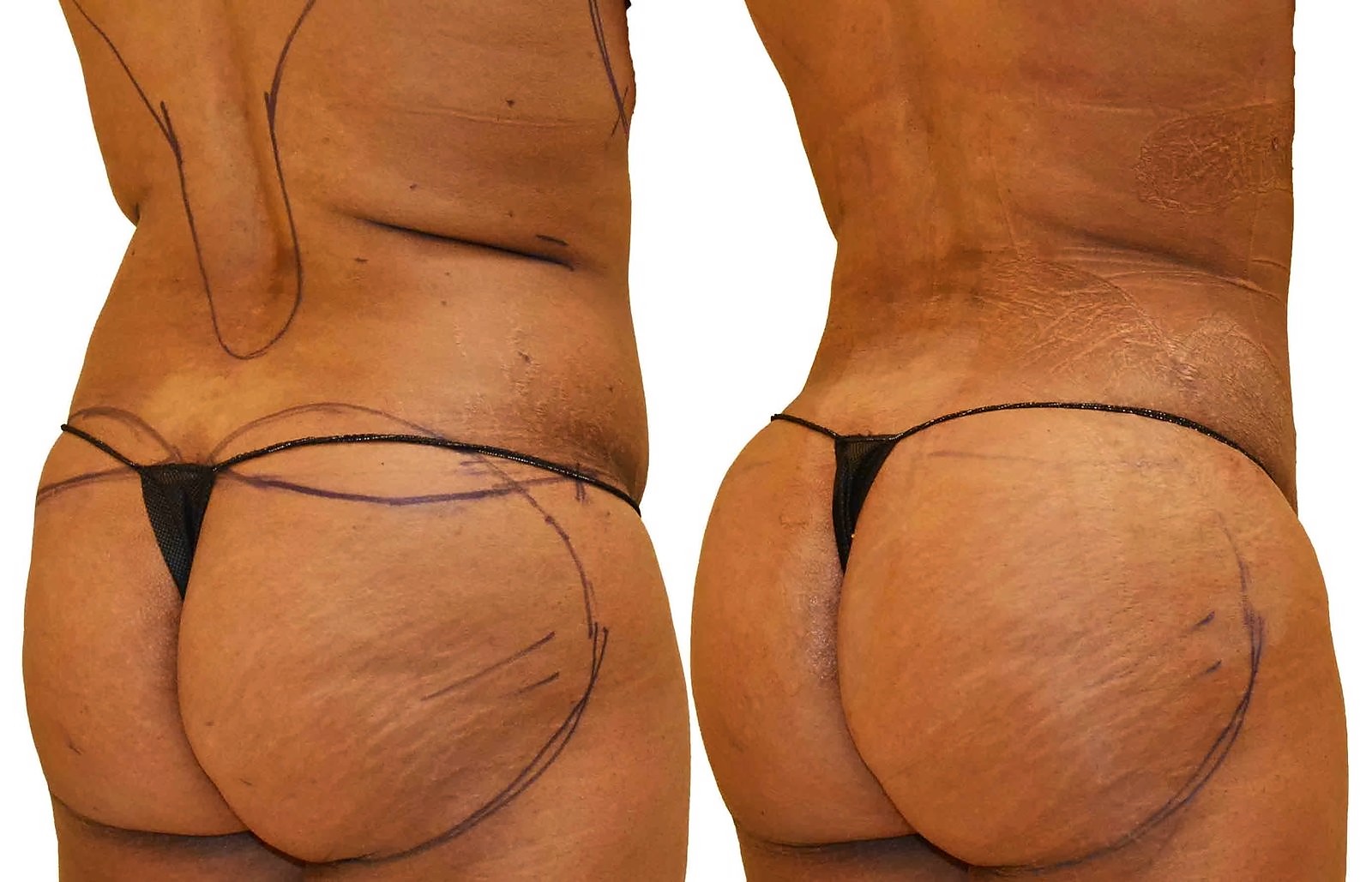 Before/After Fat Transfer, BBL before and after, actual patient of Dr. Long