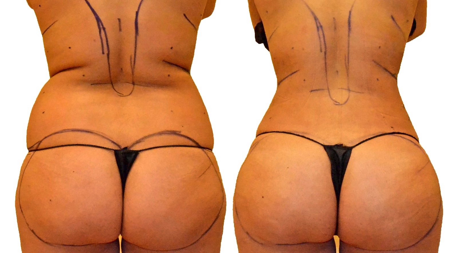 Before/After Fat Transfer, BBL before and after, actual patient of Dr. Long