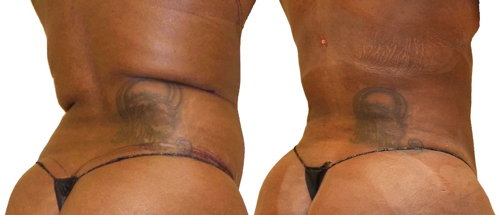 Before/After Fat Transfer, BBL before and after, actual patient of Dr. Long
