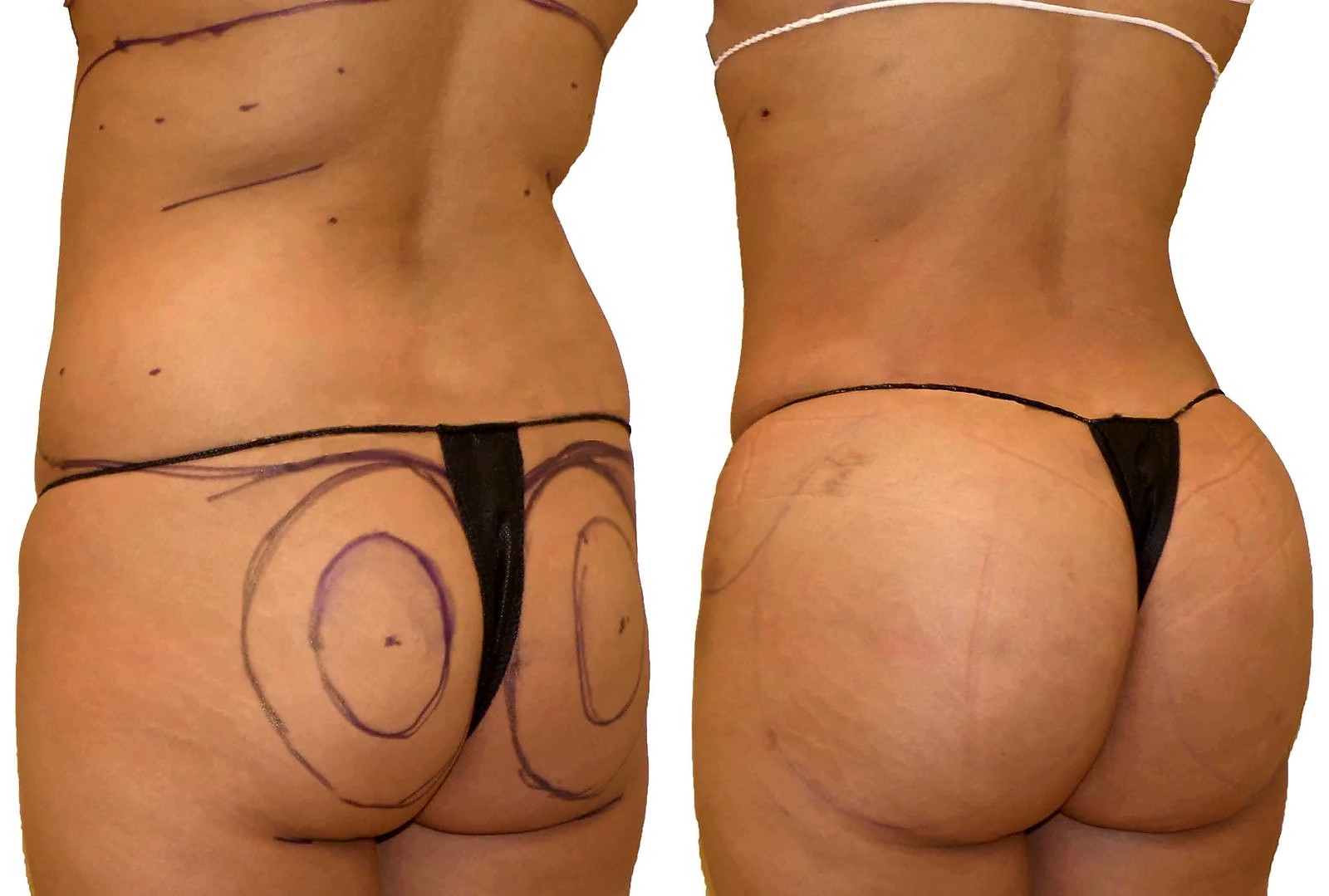 Before/After Fat Transfer, BBL before and after, actual patient of Dr. Long