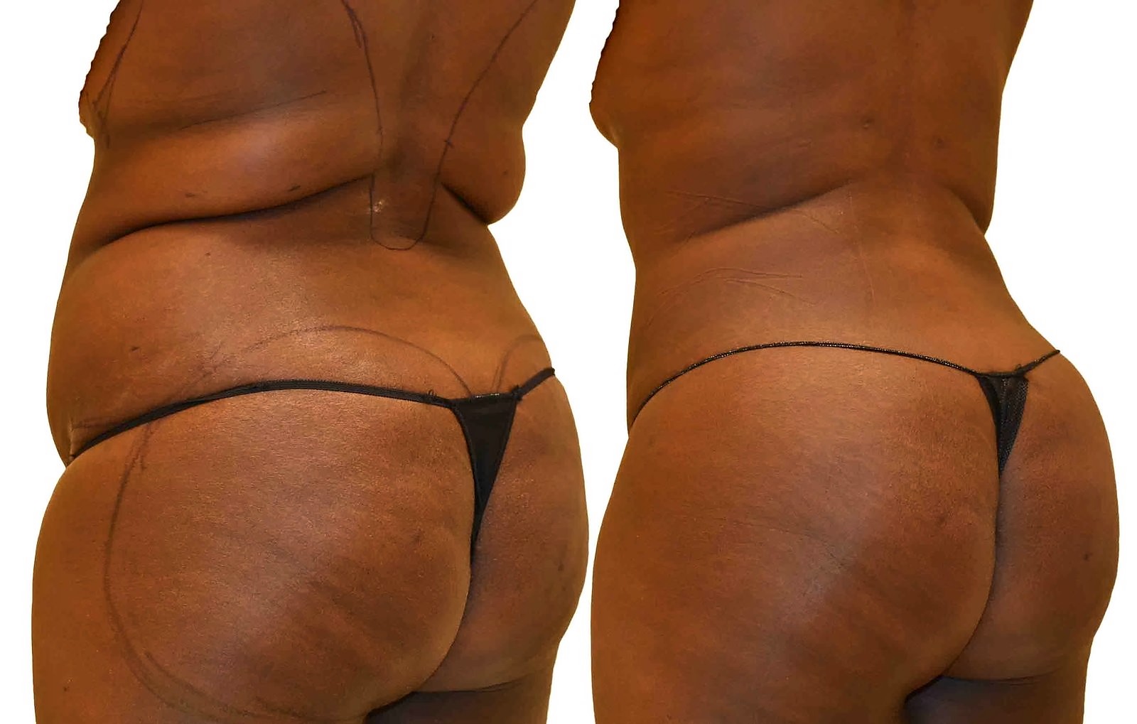 Before/After Fat Transfer, BBL before and after, actual patient of Dr. Long