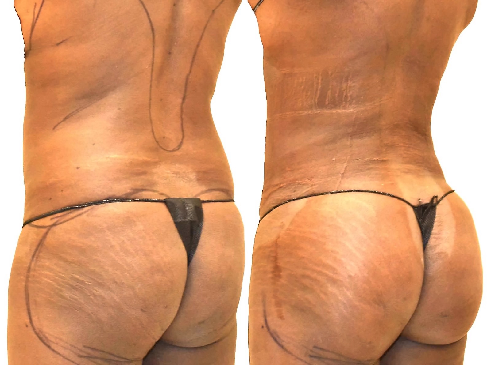 Before/After Fat Transfer, BBL before and after, actual patient of Dr. Long