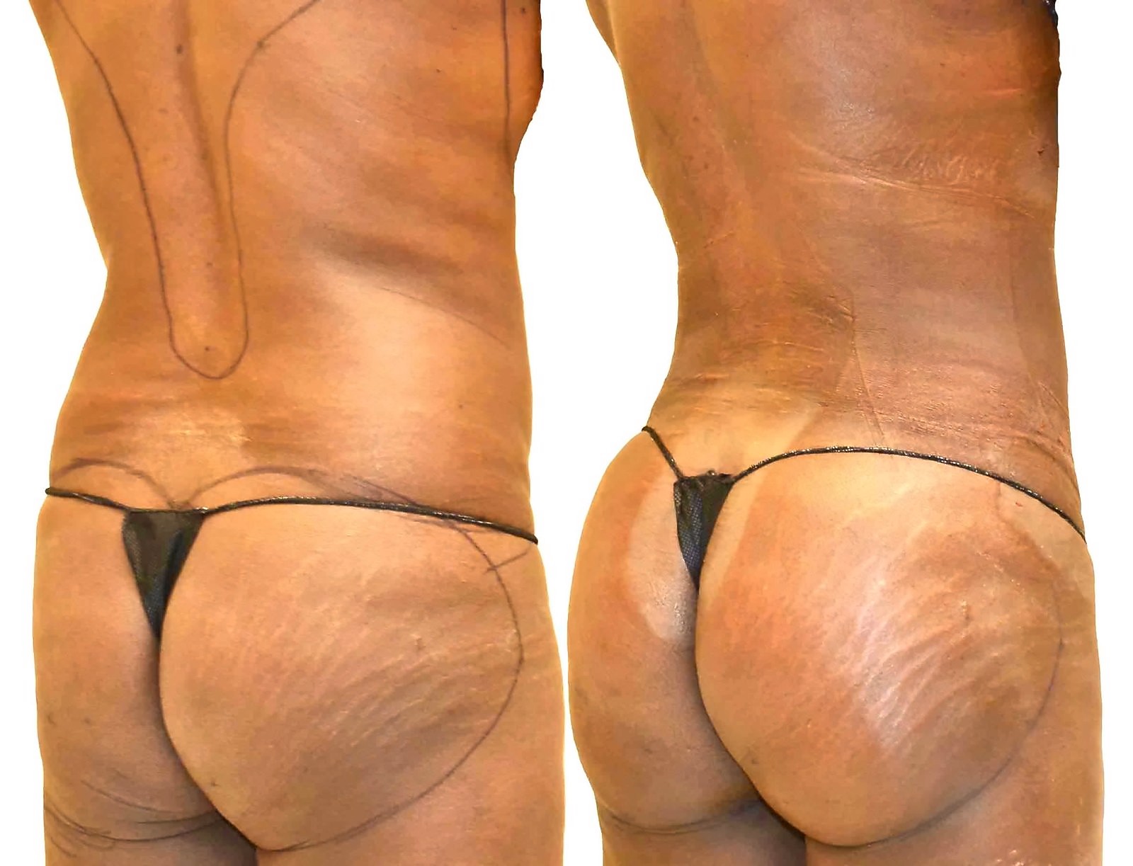 Before/After Fat Transfer, BBL before and after, actual patient of Dr. Long