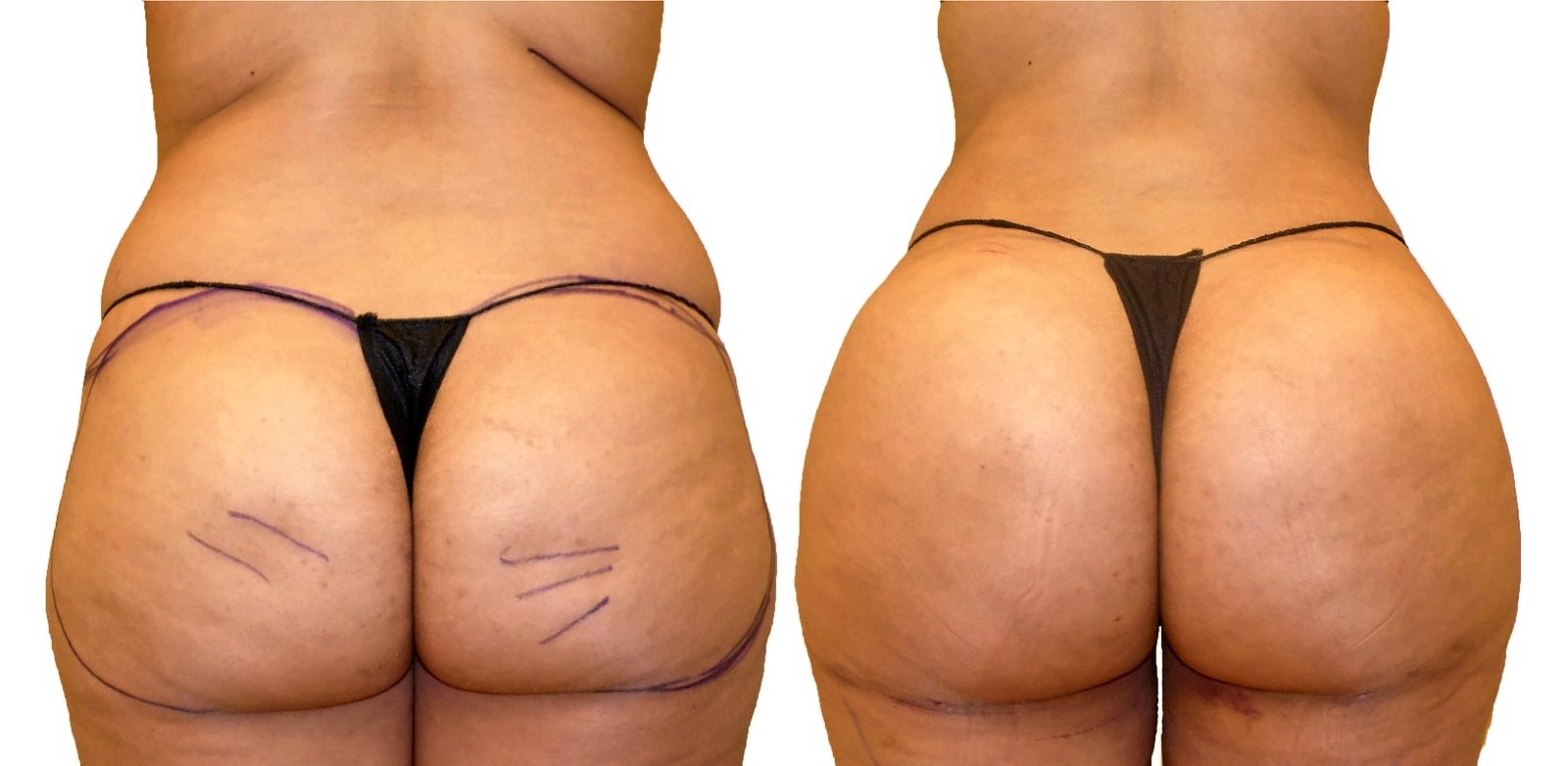 Before/After Fat Transfer, BBL before and after, actual patient of Dr. Long