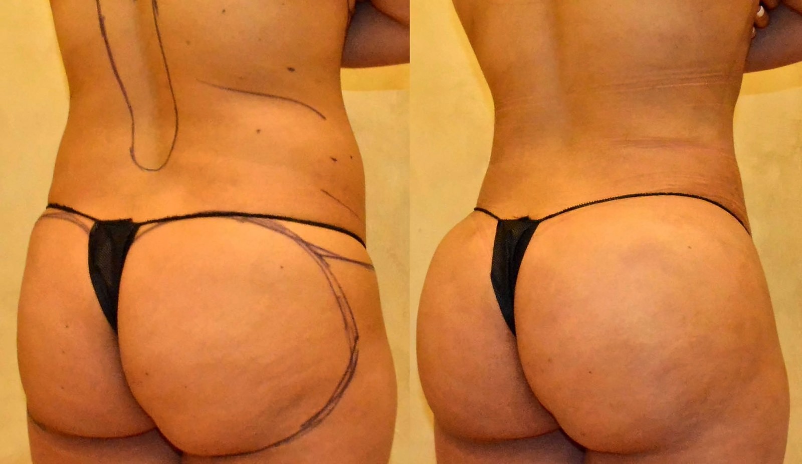 Before/After Fat Transfer, BBL before and after, actual patient of Dr. Long