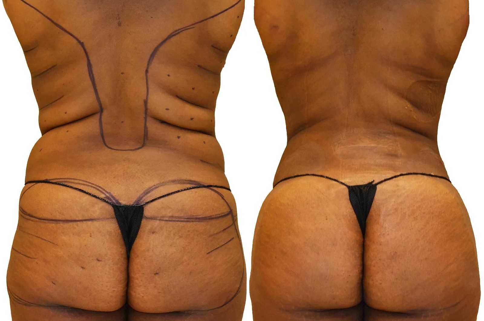 Before/After Fat Transfer, BBL before and after, actual patient of Dr. Long