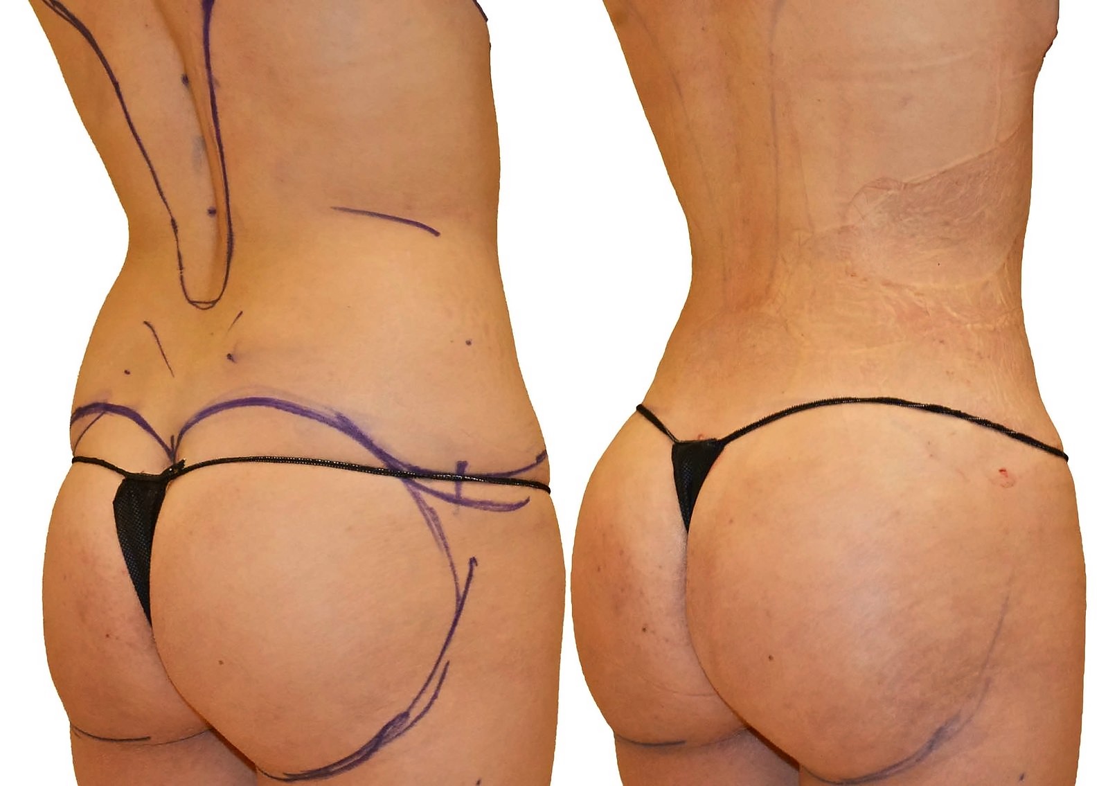 Before/After Fat Transfer, BBL before and after, actual patient of Dr. Long