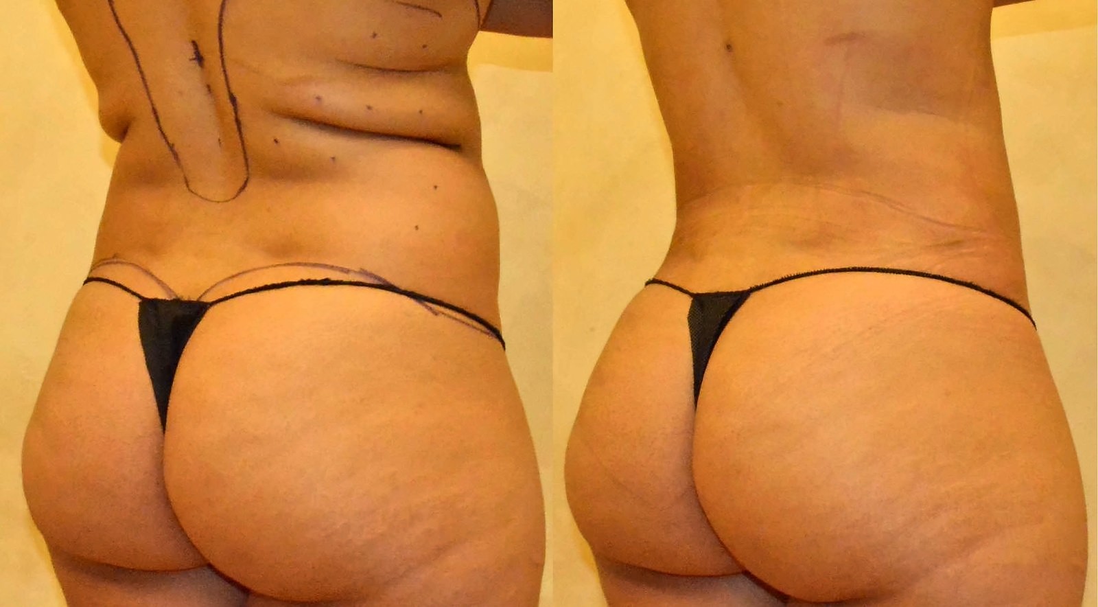 Before/After Fat Transfer, BBL before and after, actual patient of Dr. Long
