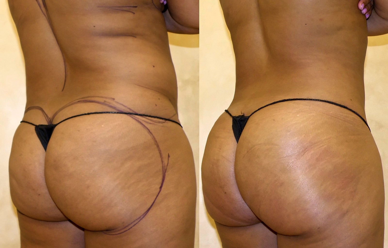 Before/After Fat Transfer, BBL before and after, actual patient of Dr. Long