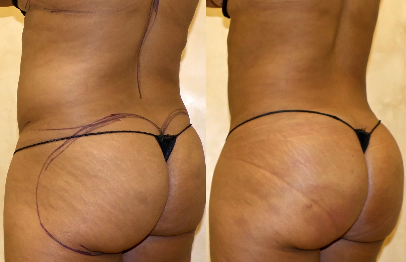 Before/After Fat Transfer, BBL before and after, actual patient of Dr. Long