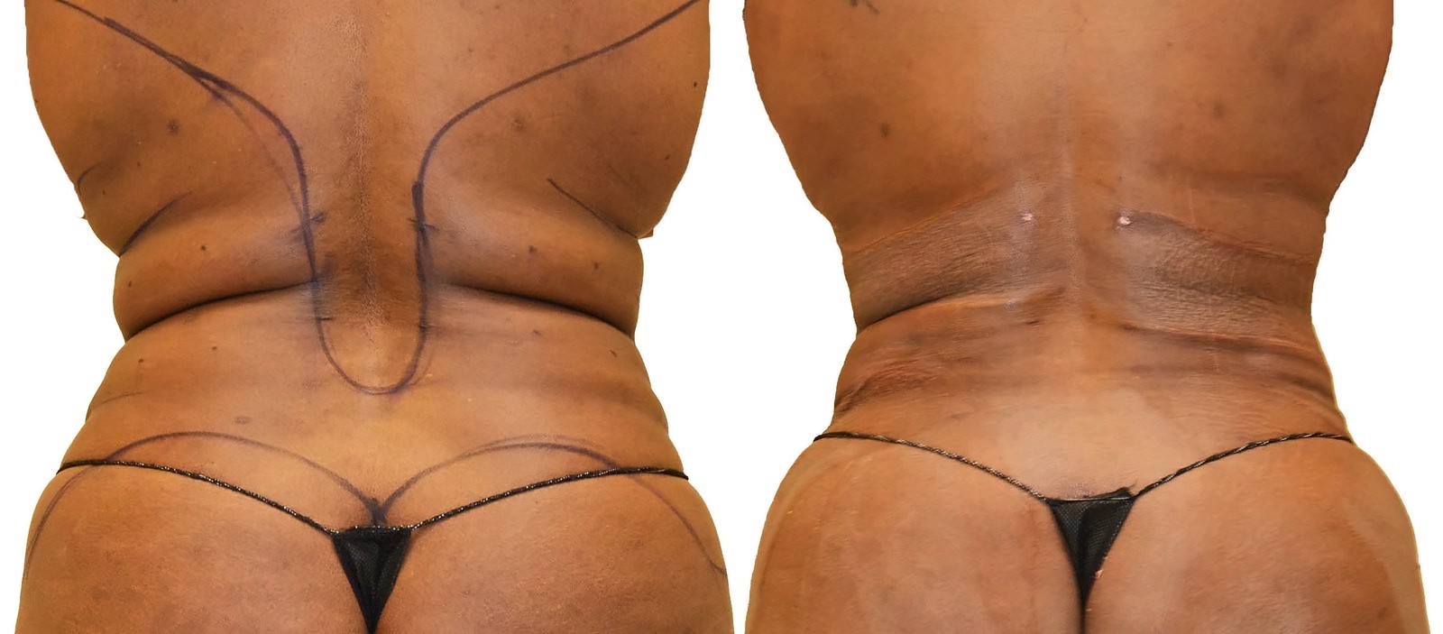 Before/After Fat Transfer, BBL before and after, actual patient of Dr. Long