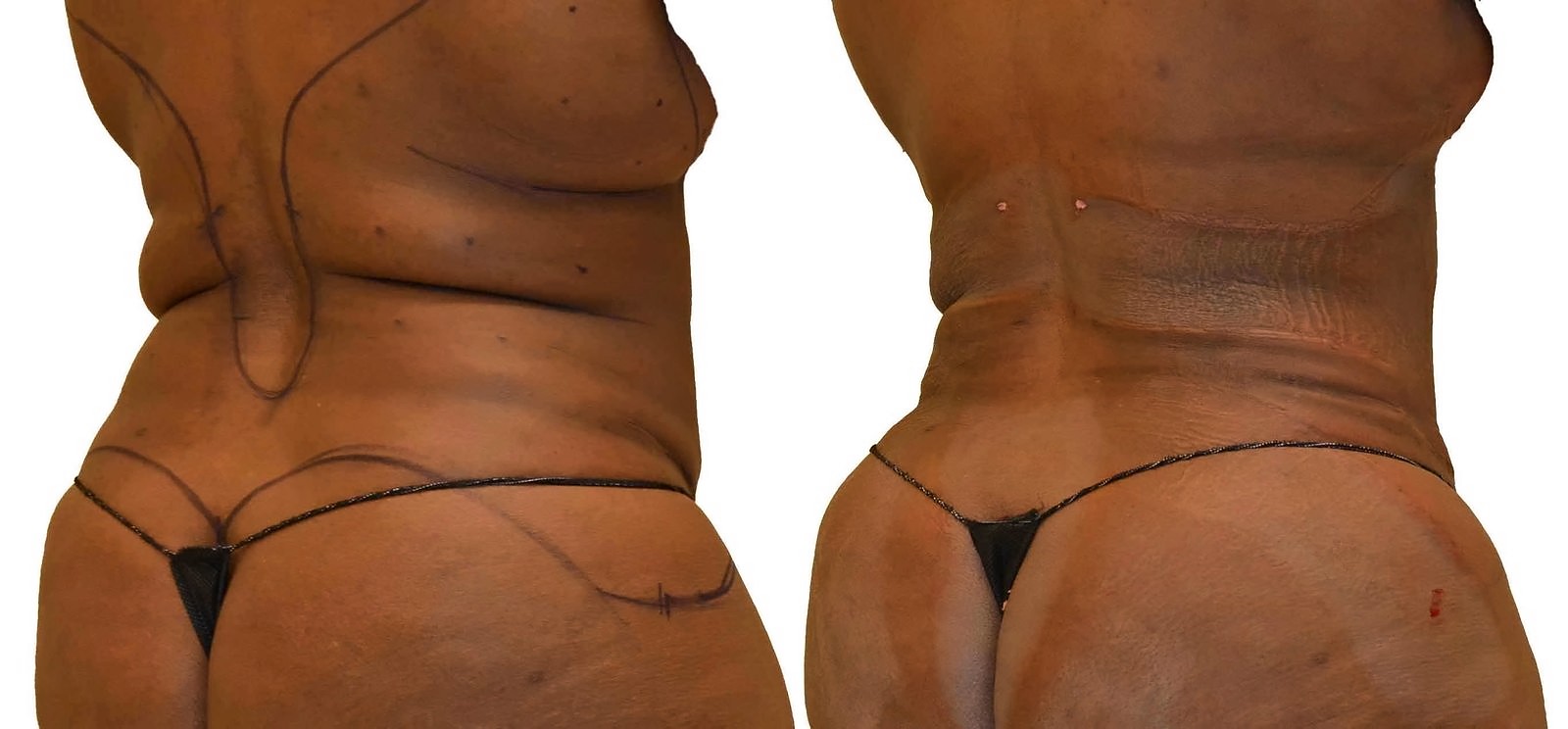 Before/After Fat Transfer, BBL before and after, actual patient of Dr. Long