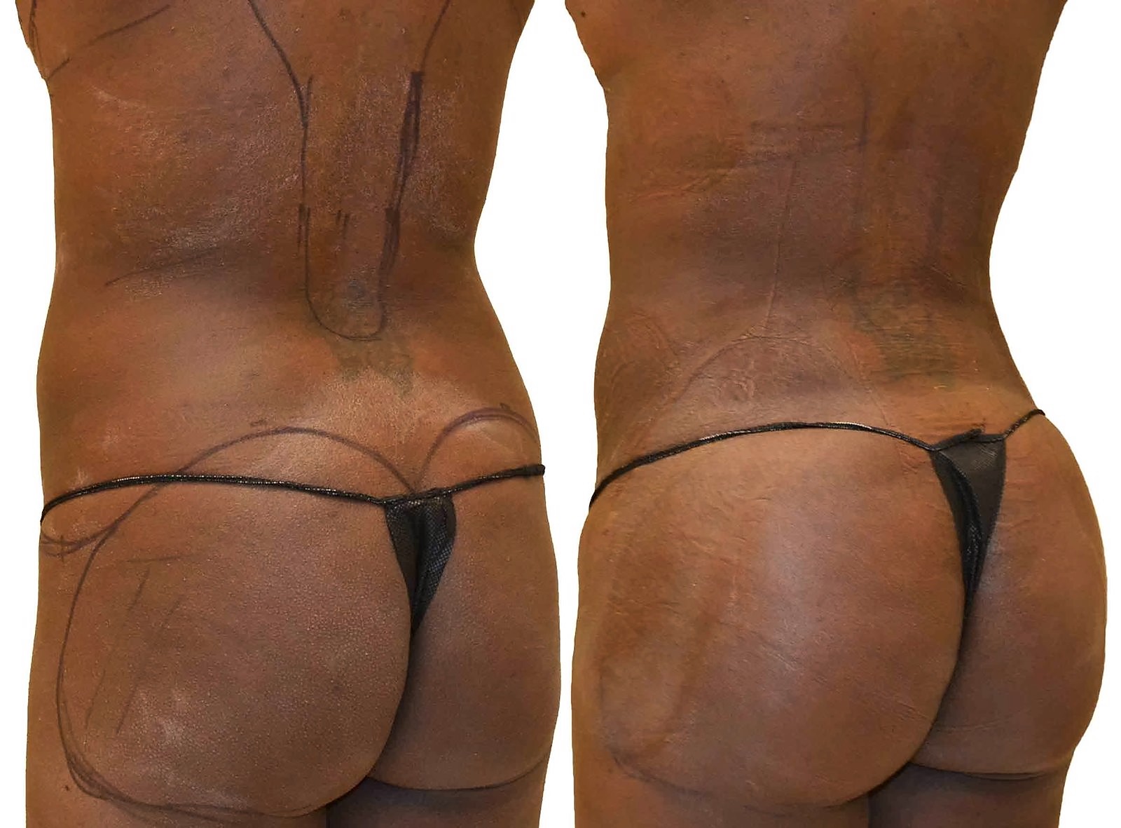 Before/After Fat Transfer, BBL before and after, actual patient of Dr. Long