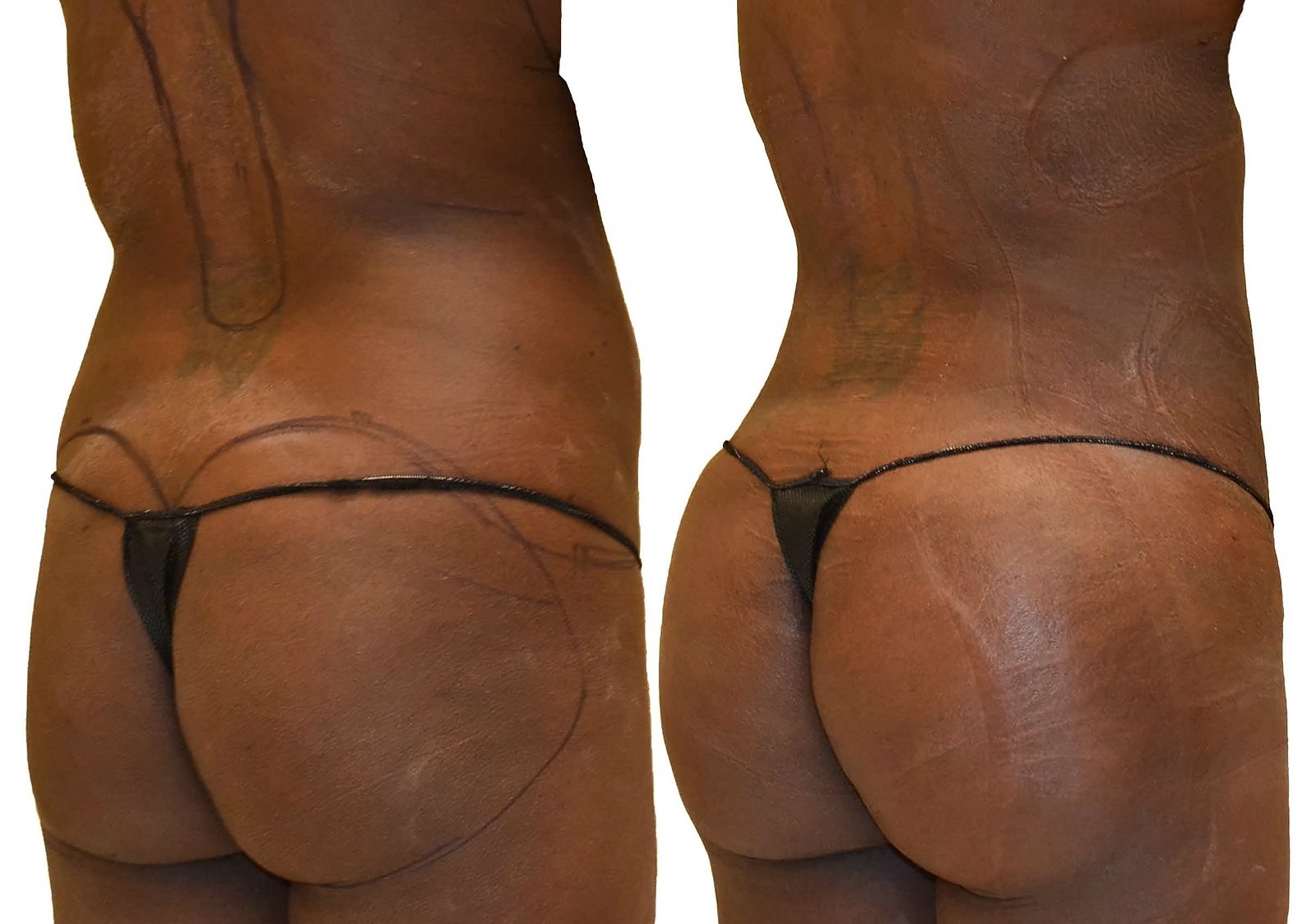 Before/After Fat Transfer, BBL before and after, actual patient of Dr. Long