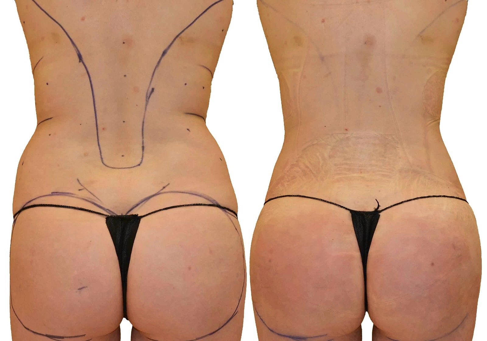 Before/After Fat Transfer, BBL before and after, actual patient of Dr. Long