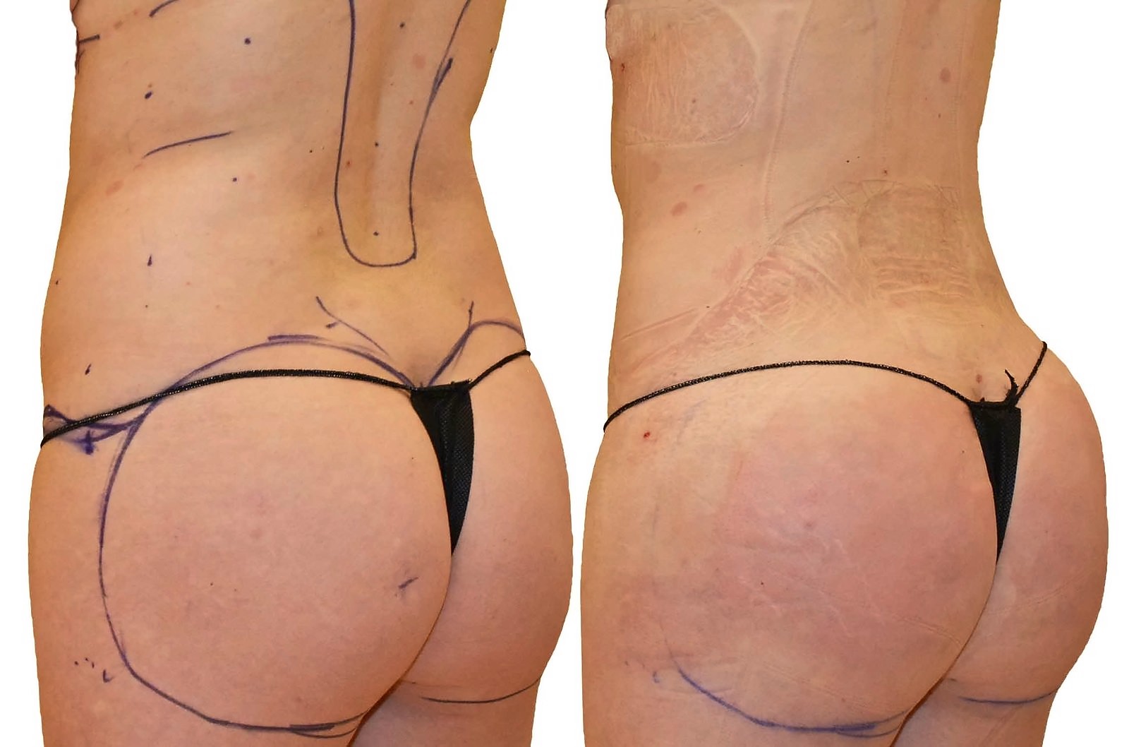 Before/After Fat Transfer, BBL before and after, actual patient of Dr. Long