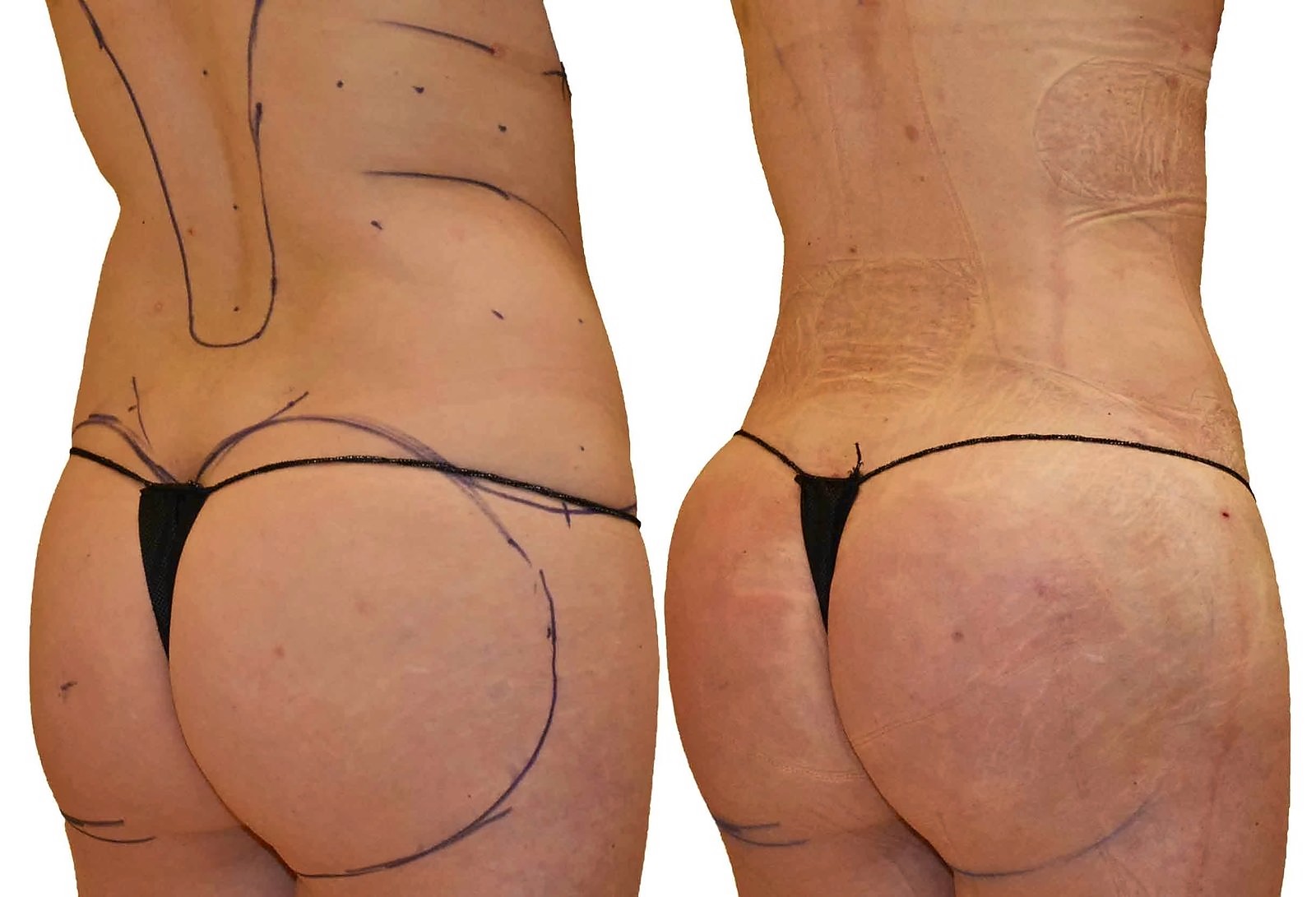 Before/After Fat Transfer, BBL before and after, actual patient of Dr. Long