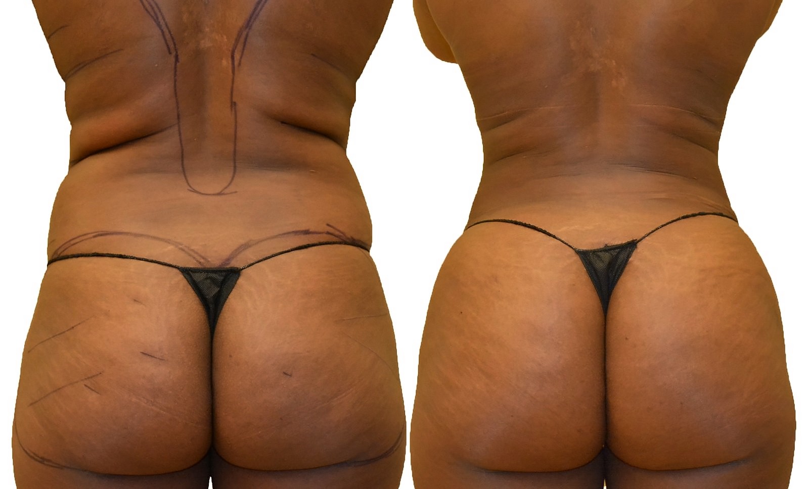 Before/After Fat Transfer, BBL before and after, actual patient of Dr. Long