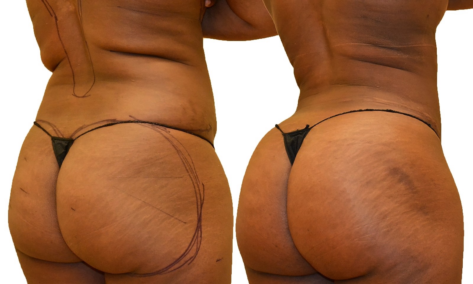 Before/After Fat Transfer, BBL before and after, actual patient of Dr. Long
