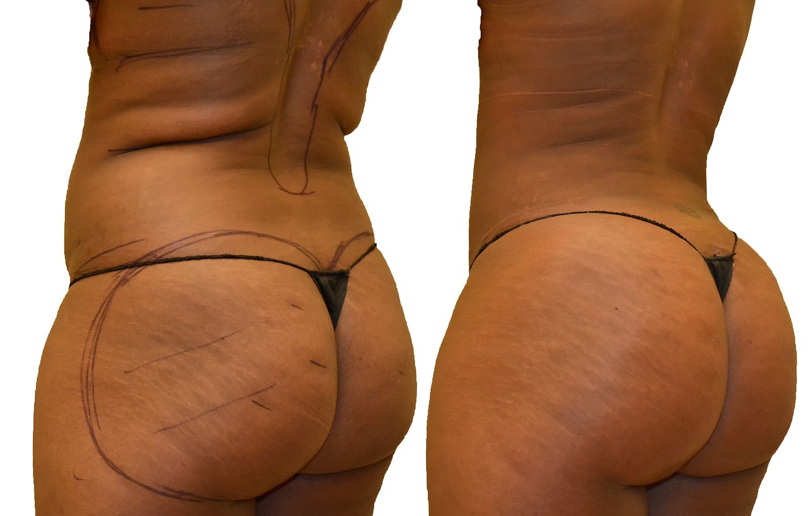 Before/After Fat Transfer, BBL before and after, actual patient of Dr. Long